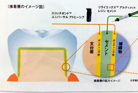 レジンセメント２.jpeg
