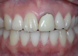 上顎前歯のオールセラミックとレジン充填治療－長崎市の歯科・歯医者・インプラント・口腔がん・口腔外科なら山辺歯科