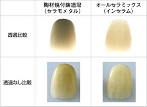 オールセラミック治療とは