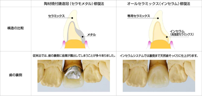 オールセラミック治療とは