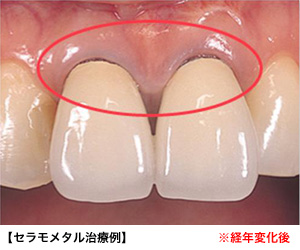 オールセラミック治療とは