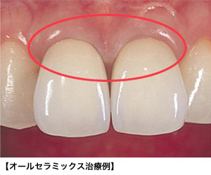 オールセラミック治療とは