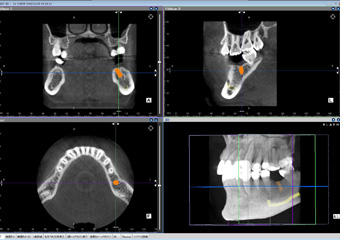 歯科用CT