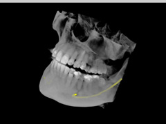 歯科用CT