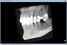 歯科用CT