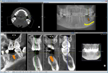 歯科用CT