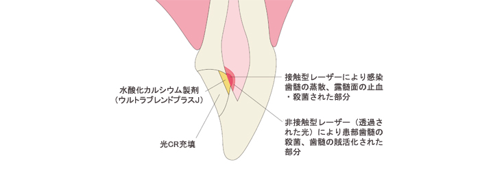 オサダライトサージ3000