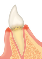 歯肉炎と歯周病の治療