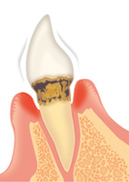 歯肉炎と歯周病の治療